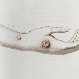 Coloured depiction of lesion on a hand