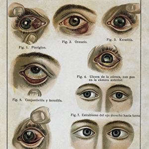 Enfermedades de los ojos (Eye diseases). Engraving
