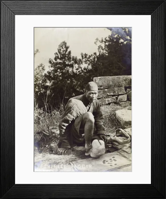 Framed Print : China - Chinese Beggar with severe elephantiasis of the foot Framed Print : China - Chinese Beggar with severe elephantiasis of the foot