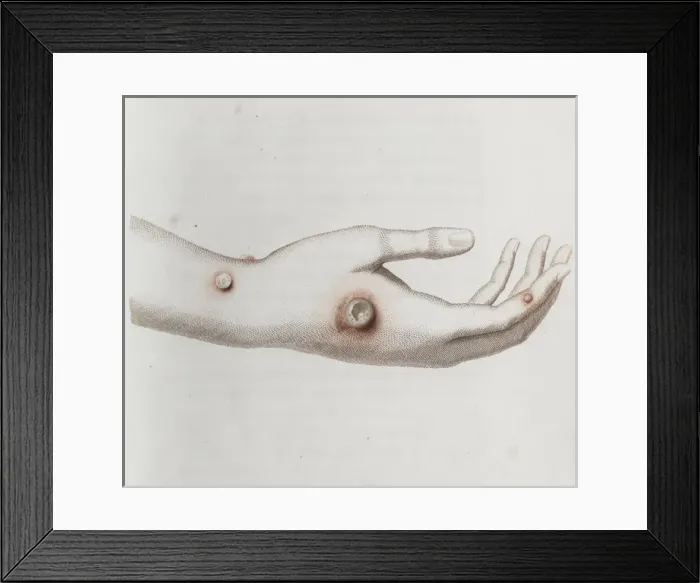 Framed Print : Coloured depiction of lesion on a hand Framed Print : Coloured depiction of lesion on a hand