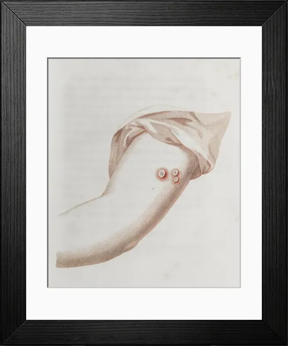 Framed Print : Coloured depiction of lesion on arm Framed Print : Coloured depiction of lesion on arm