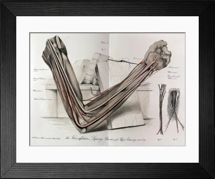 Framed Print : The nerves of the arm in Leprosy Framed Print : The nerves of the arm in Leprosy