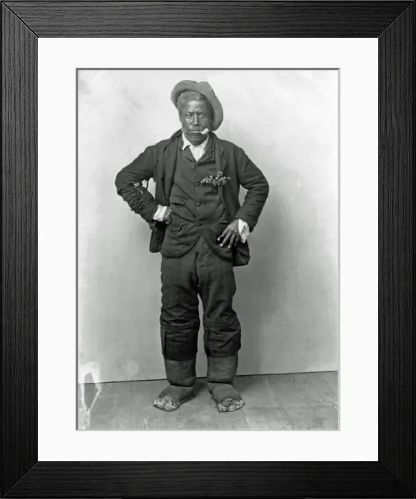 Framed Print : Man with Elephantiasis, West Indies Framed Print : Man with Elephantiasis, West Indies