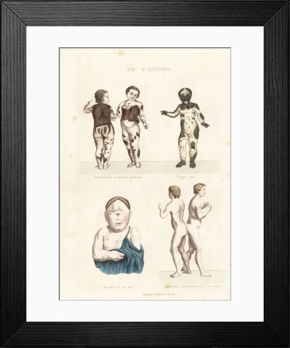 Framed Print : Human disorders Framed Print : Human disorders