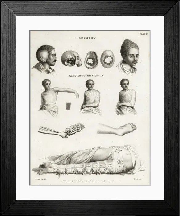 Framed Print : Surgical procedures from the 19th century Framed Print : Surgical procedures from the 19th century