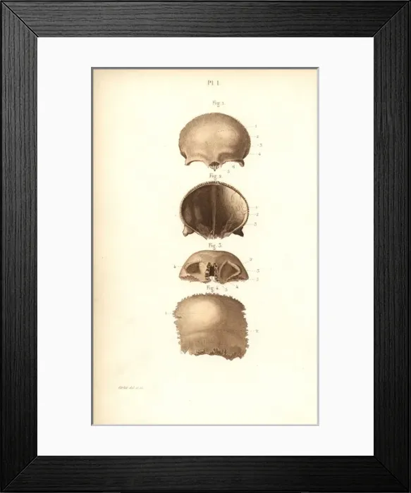 Framed Print : Frontal bones of the skull Framed Print : Frontal bones of the skull