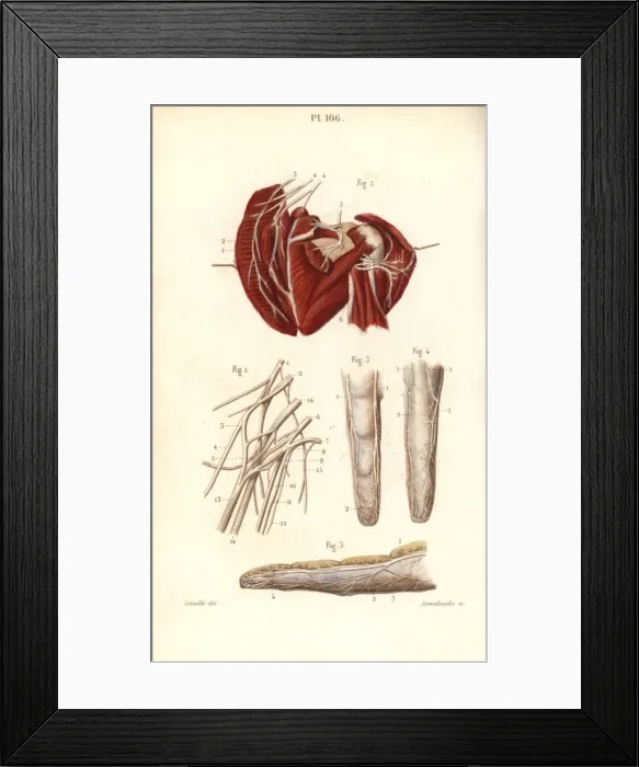 Framed Print : Nerves to the brachial plexus and the finger Framed Print : Nerves to the brachial plexus and the finger