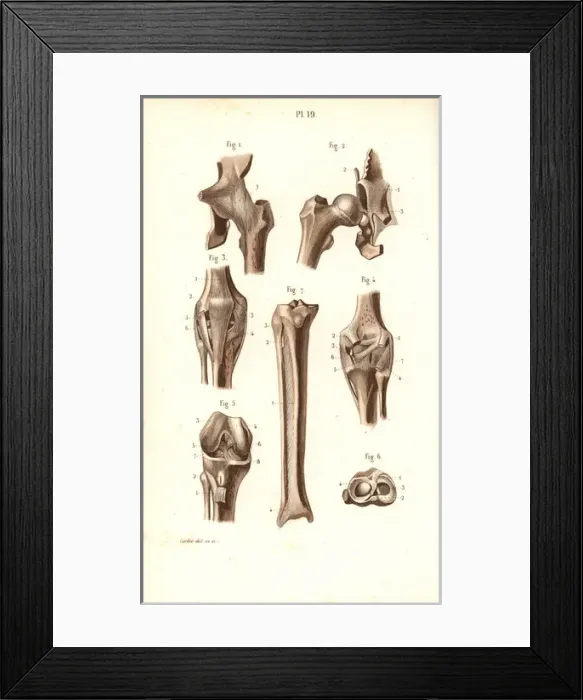 Framed Print : Hip joint and thigh bones Framed Print : Hip joint and thigh bones
