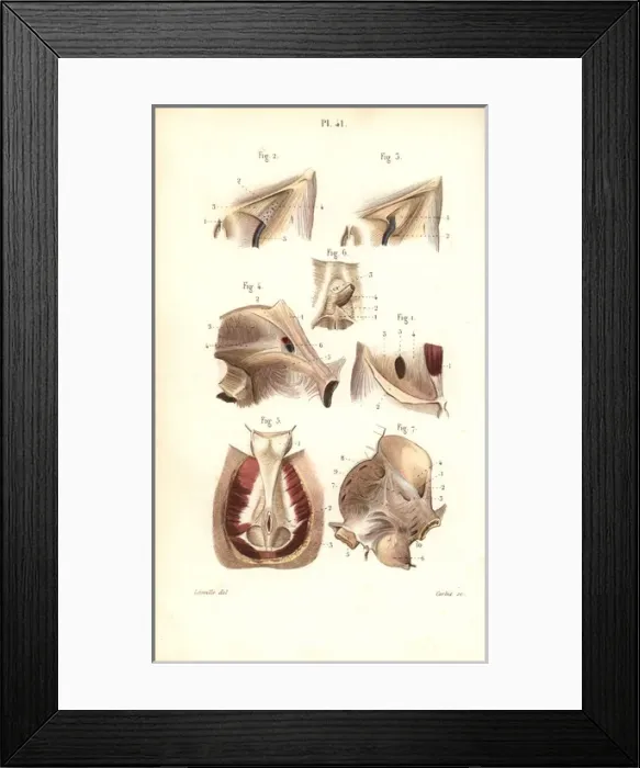 Framed Print : Aponeuroses of the abdomen and perineum Framed Print : Aponeuroses of the abdomen and perineum
