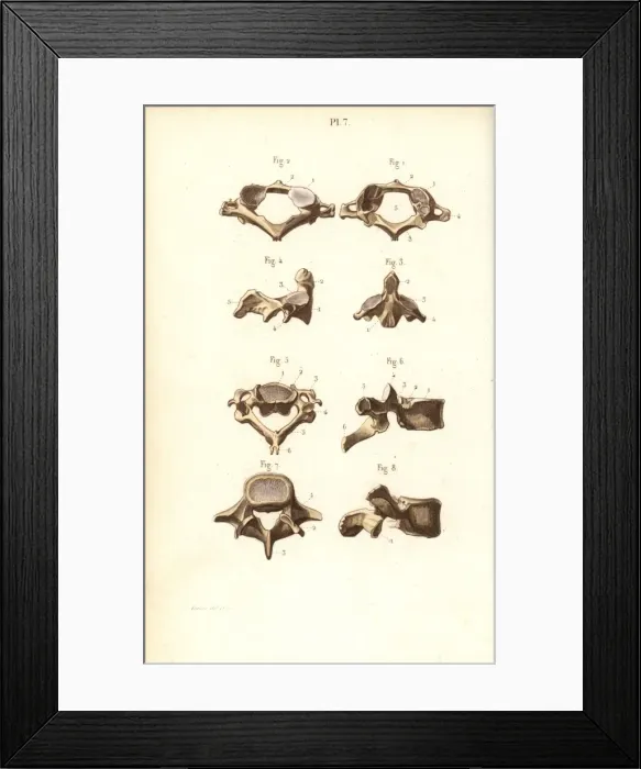 Framed Print : Axis and vertebrae Framed Print : Axis and vertebrae
