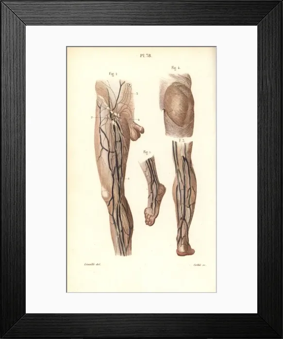 Framed Print : Lymphatic system in the leg and foot Framed Print : Lymphatic system in the leg and foot