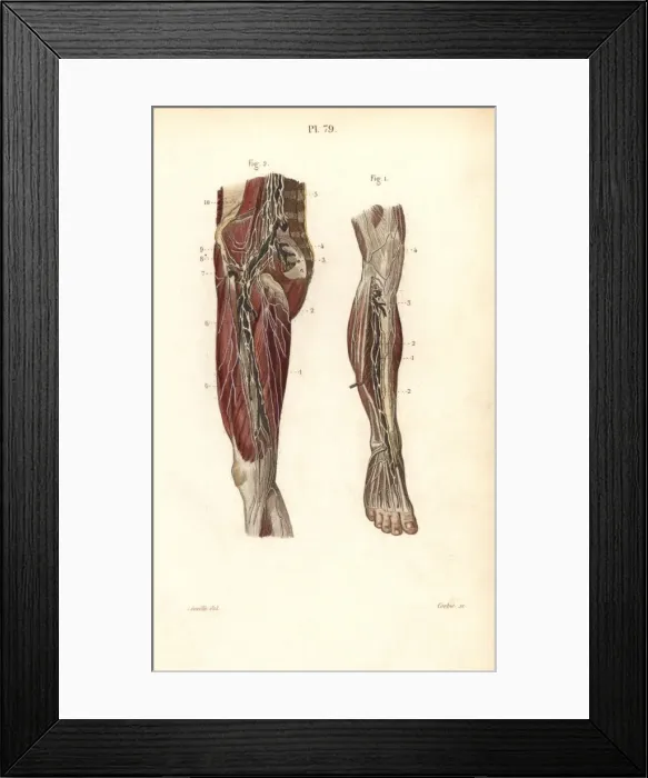 Framed Print : Lymph nodes and vessels deep in the leg Framed Print : Lymph nodes and vessels deep in the leg