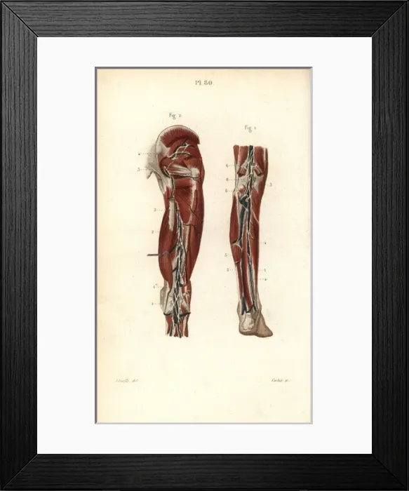Framed Print : Lymph nodes and vessels deep in the back of the leg Framed Print : Lymph nodes and vessels deep in the back of the leg