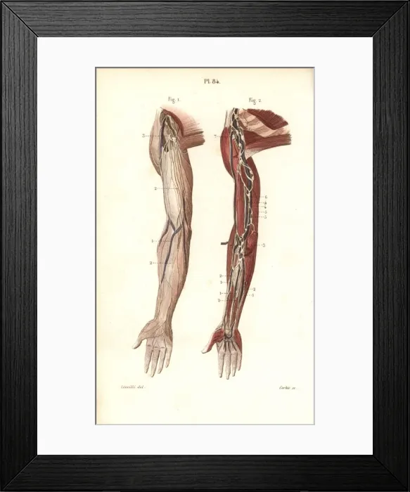 Framed Print : Lymphatic system in the arm Framed Print : Lymphatic system in the arm