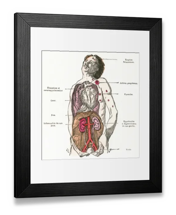 Framed Print : Diagram / Diabetes / 1883 Framed Print : Diagram / Diabetes / 1883