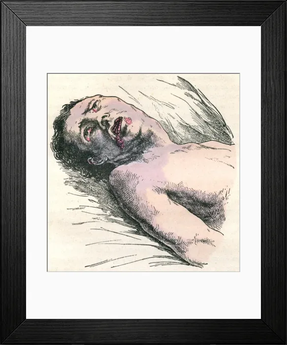 Framed Print : EPILEPSY. Diagram to show an unconscious victim of a strong epilectic attack Date: 1883 Framed Print : EPILEPSY. Diagram to show an unconscious victim of a strong epilectic attack Date: 1883