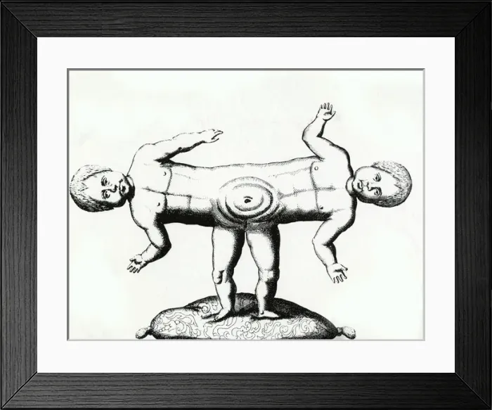 Framed Print : Siamese Twins / C18Th Framed Print : Siamese Twins / C18Th