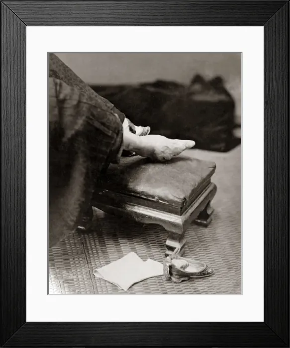 Framed Print : Bound foot, China, circa 1880s Framed Print : Bound foot, China, circa 1880s