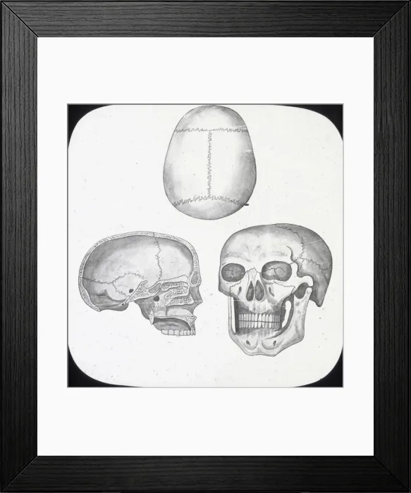Framed Print : X-Ray - Skull, Front, Top-and Section Framed Print : X-Ray - Skull, Front, Top-and Section