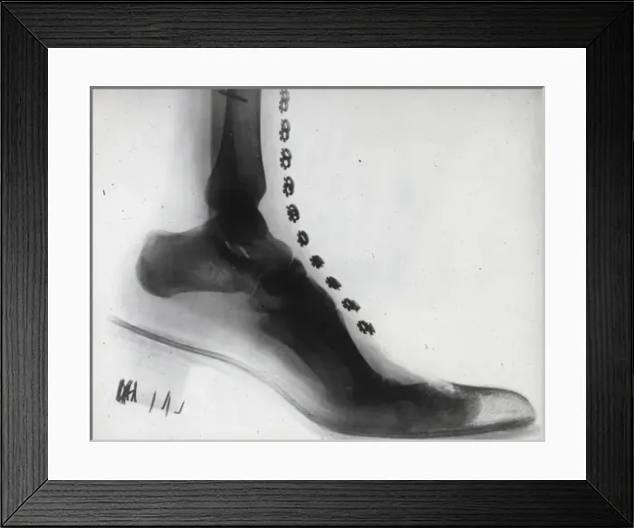 Framed Print : X-Ray - Human Foot Framed Print : X-Ray - Human Foot