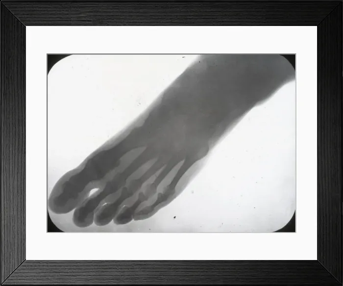 Framed Print : X-Ray - Human Foot Framed Print : X-Ray - Human Foot