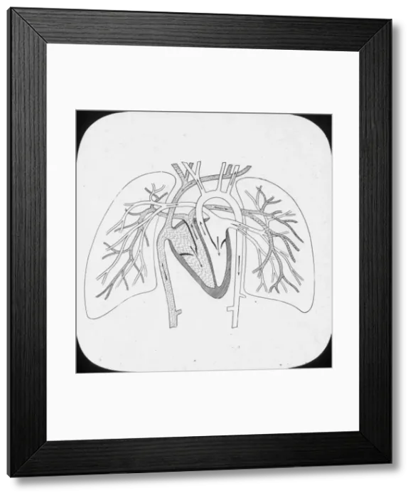 Framed Print : X-Ray - Pulmonary Circulation Framed Print : X-Ray - Pulmonary Circulation