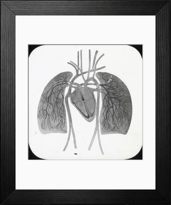 Framed Print : X-Ray - Pulmonary Circulation Framed Print : X-Ray - Pulmonary Circulation