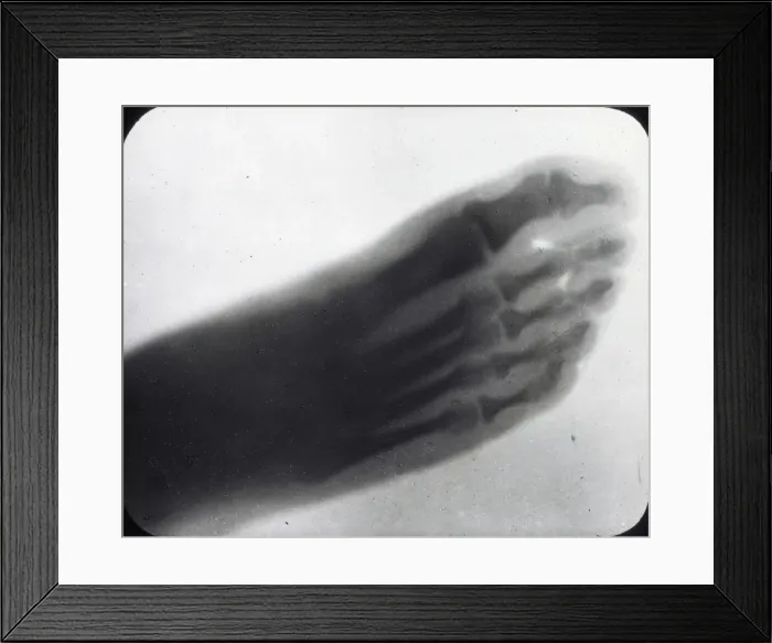 Framed Print : X-Ray - Human Foot Framed Print : X-Ray - Human Foot
