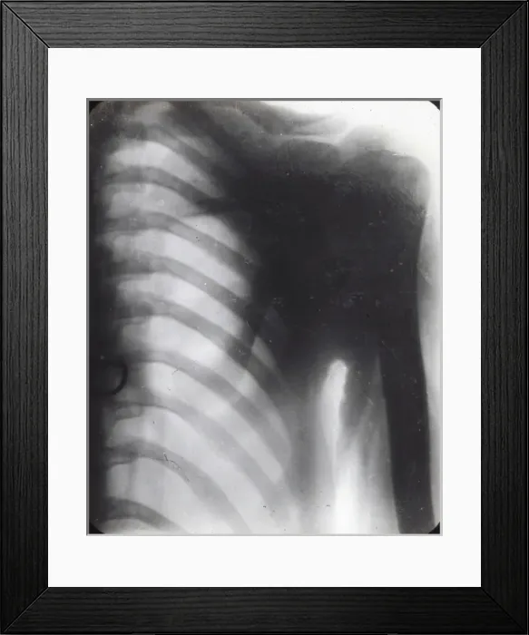 Framed Print : X-Ray - Human Male Chest Framed Print : X-Ray - Human Male Chest
