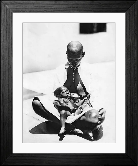 Framed Print : Child with Yaws, Mombasa, Kenya, East Africa Framed Print : Child with Yaws, Mombasa, Kenya, East Africa