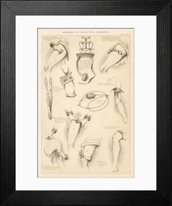 Framed Print : Methods of Arresting Bleeding with various tourniquets Framed Print : Methods of Arresting Bleeding with various tourniquets