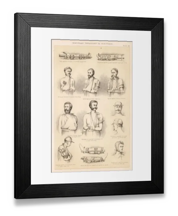 Framed Print : Temporary Treatment of Bone Fractures Framed Print : Temporary Treatment of Bone Fractures