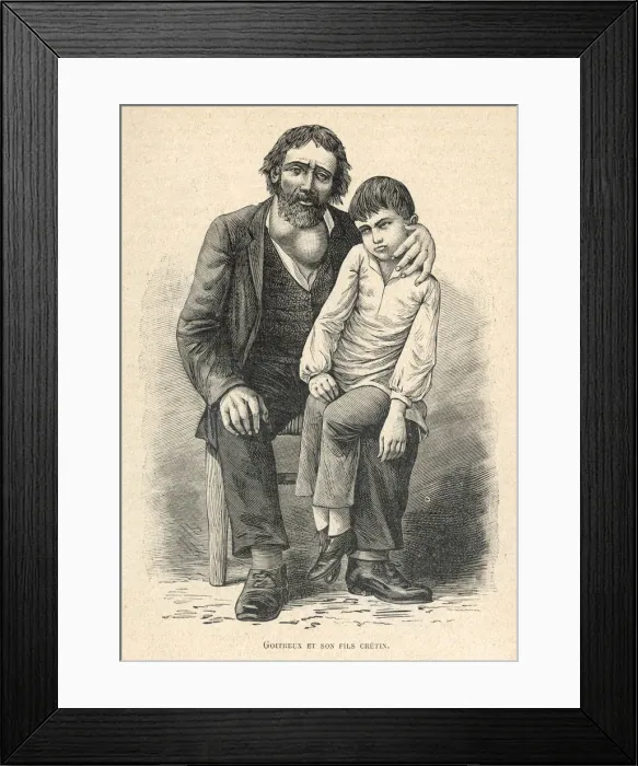 Framed Print : MAN WITH GOITRE AND SON Framed Print : MAN WITH GOITRE AND SON