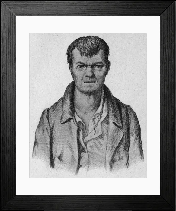 Framed Print : Man with mental disability and goitre Framed Print : Man with mental disability and goitre