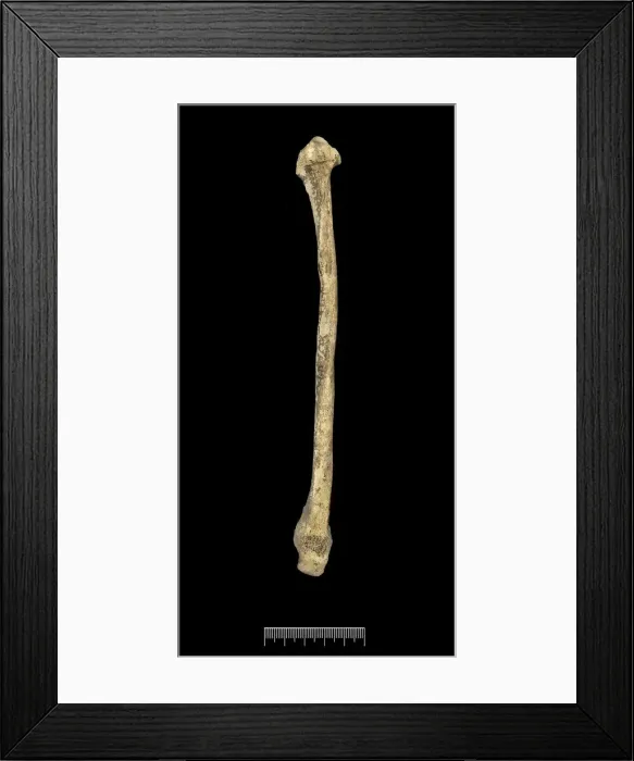 Framed Print : Fibula of Achondroplastic Dwarf Framed Print : Fibula of Achondroplastic Dwarf
