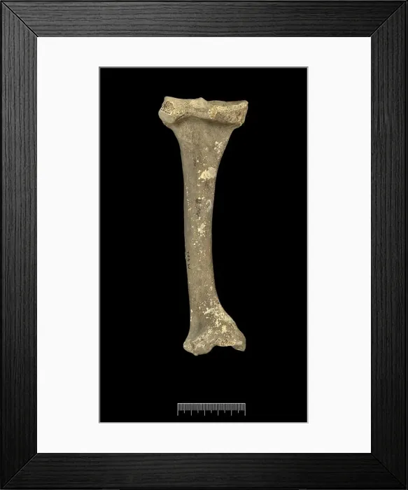 Framed Print : Tibia of Achondroplastic Dwarf Framed Print : Tibia of Achondroplastic Dwarf