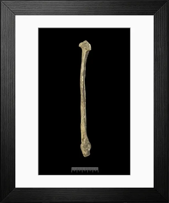 Framed Print : Fibula of Achondroplastic Dwarf Framed Print : Fibula of Achondroplastic Dwarf