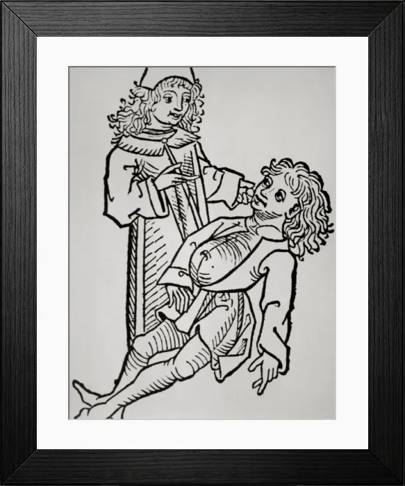 Framed Print : History of medicine. Modern Age. Belly infaldo. Cirrhosis. W Framed Print : History of medicine. Modern Age. Belly infaldo. Cirrhosis. W