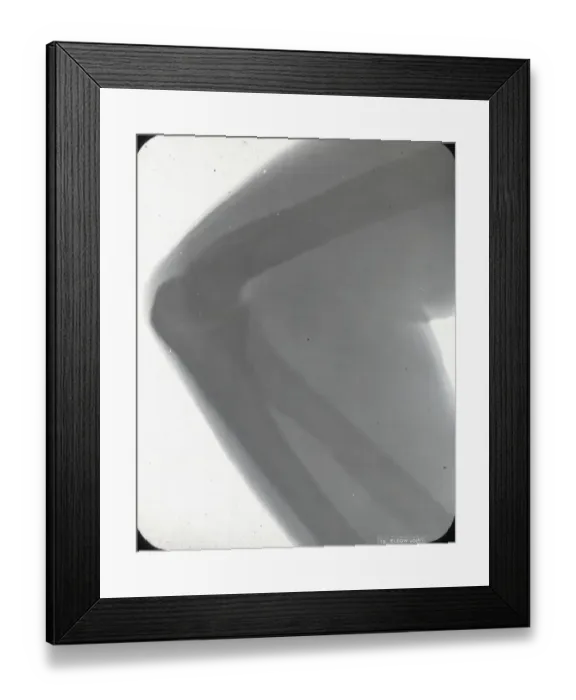 Framed Print : X-Ray - Elbow Joint Framed Print : X-Ray - Elbow Joint