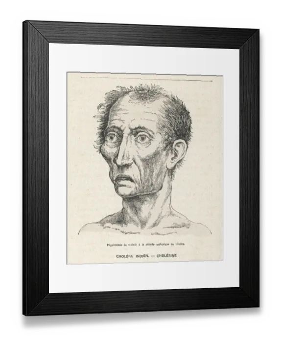 Framed Print : VICTIM OF CHOLERA / 1883 Framed Print : VICTIM OF CHOLERA / 1883