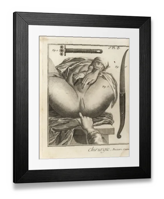 Framed Print : Fouberts surgical operation to remove a bladder stone Framed Print : Fouberts surgical operation to remove a bladder stone