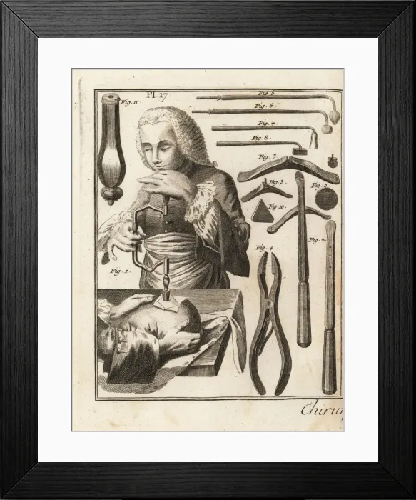 Framed Print : 18th century surgeon performing a trepanning Framed Print : 18th century surgeon performing a trepanning