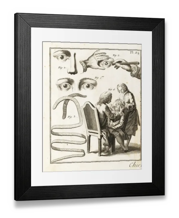 Framed Print : Eye surgery, 18th century Framed Print : Eye surgery, 18th century