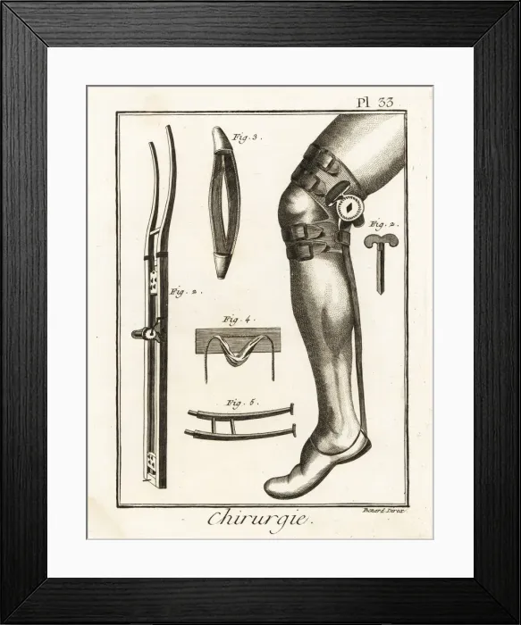 Framed Print : 18th century surgical knee pad and dislocation machine Framed Print : 18th century surgical knee pad and dislocation machine