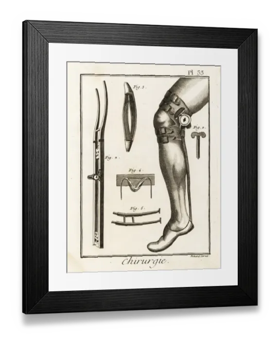 Framed Print : 18th century surgical knee pad and dislocation machine Framed Print : 18th century surgical knee pad and dislocation machine