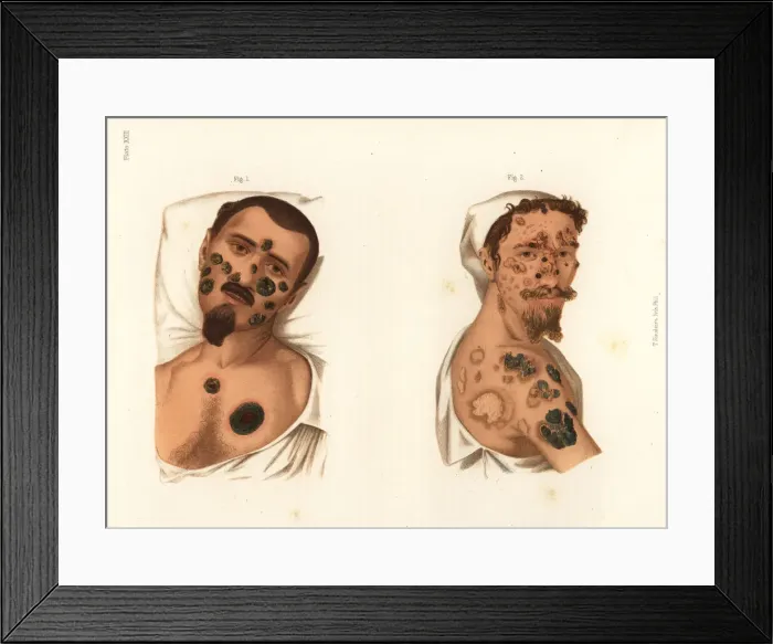 Framed Print : Secondary period syphilis symptoms on the body Framed Print : Secondary period syphilis symptoms on the body