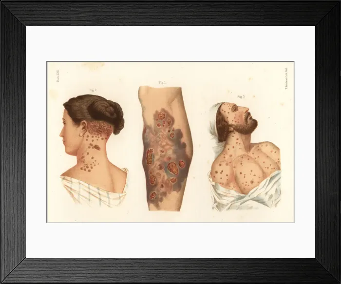 Framed Print : Syphilis symptoms on the body Framed Print : Syphilis symptoms on the body