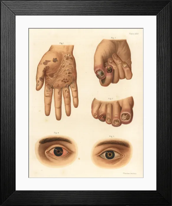 Framed Print : Secondary period syphilis symptoms on the body Framed Print : Secondary period syphilis symptoms on the body