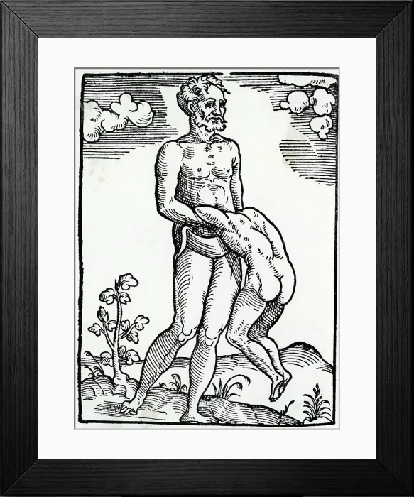 Framed Print : FREAK BIRTH / TWIN / 1560 Framed Print : FREAK BIRTH / TWIN / 1560