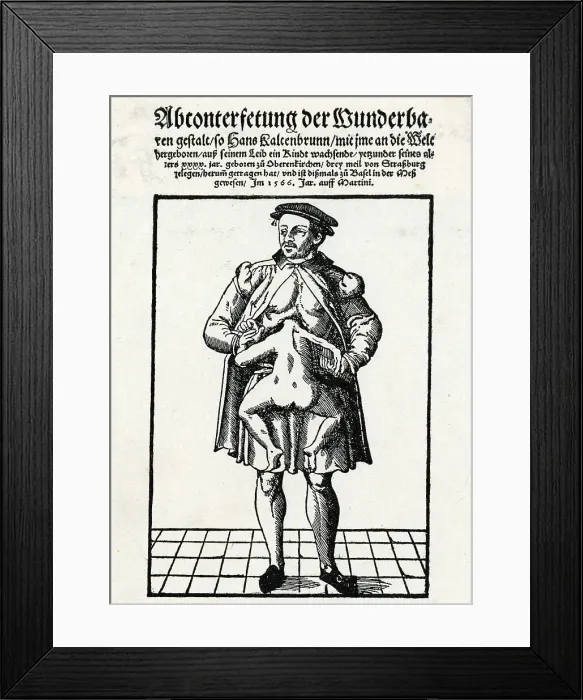 Framed Print : Freak Birth Kaltenbrunn Paranormal Human Oddities